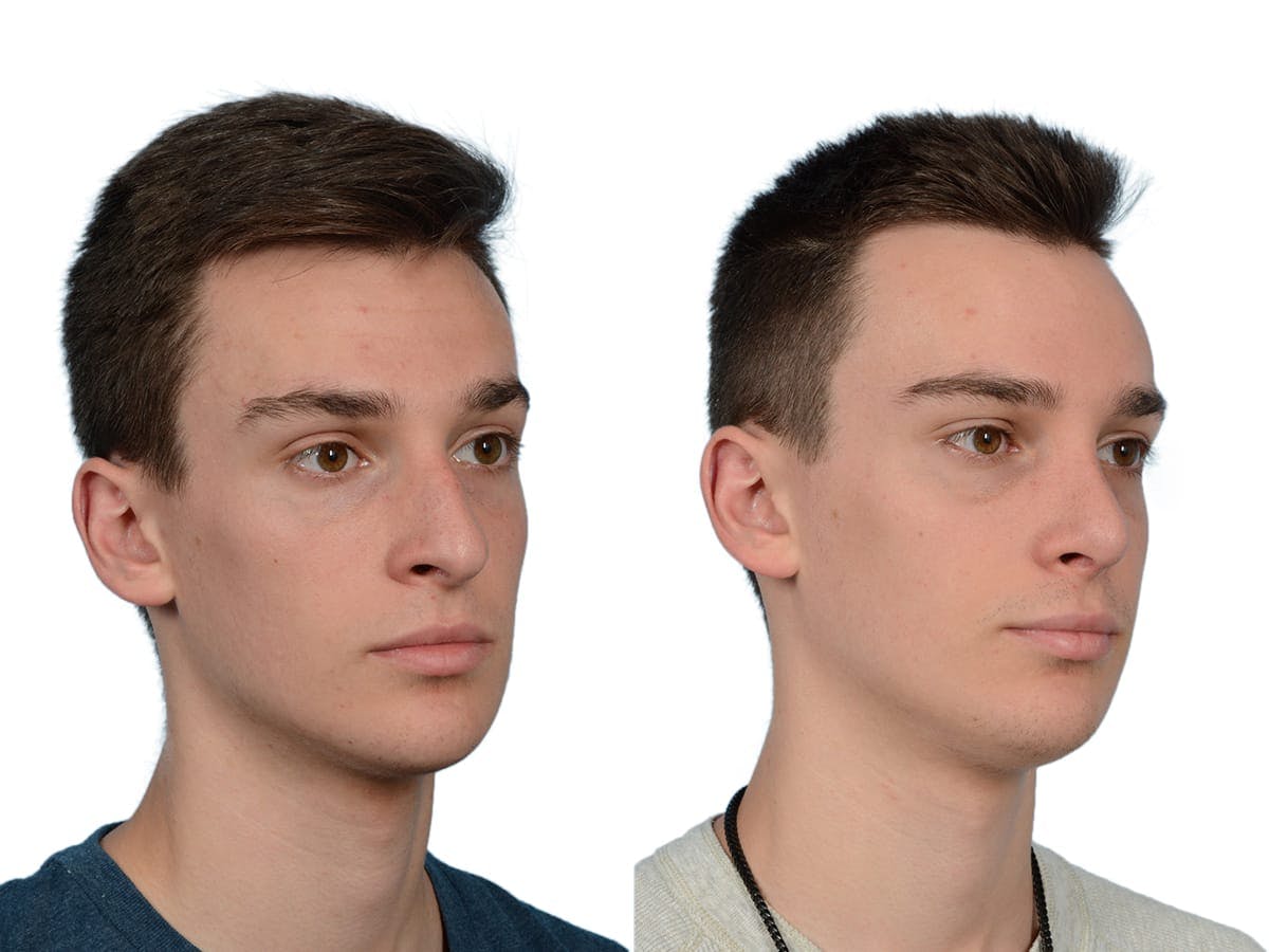 Rhinoplasty Before & After Gallery - Patient 630681 - Image 2