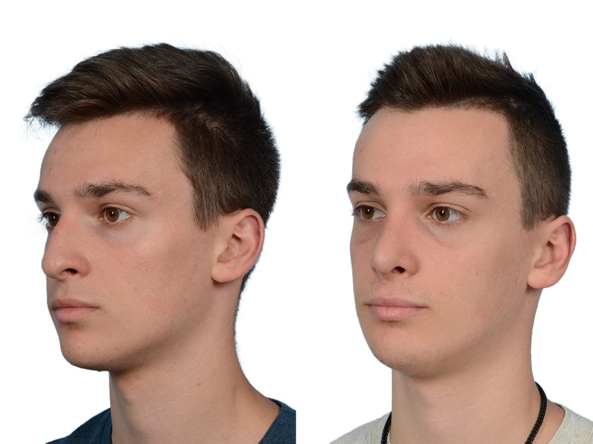 Rhinoplasty Before & After Gallery - Patient 630681 - Image 4