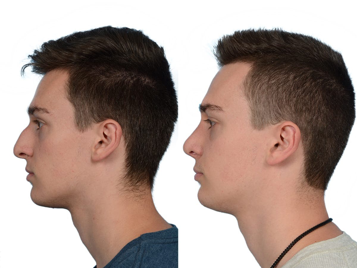 Rhinoplasty Before & After Gallery - Patient 630681 - Image 5
