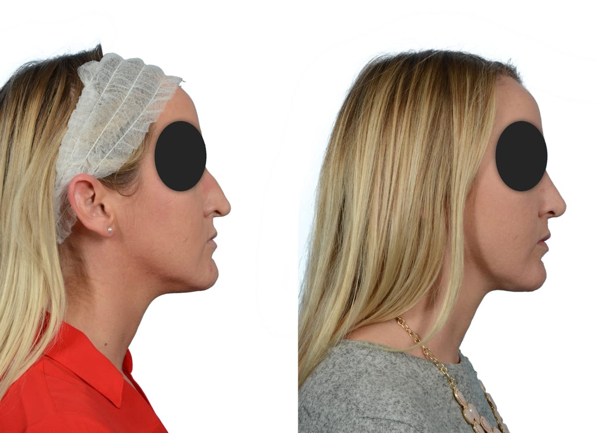 Rhinoplasty Before & After Gallery - Patient 167212 - Image 1