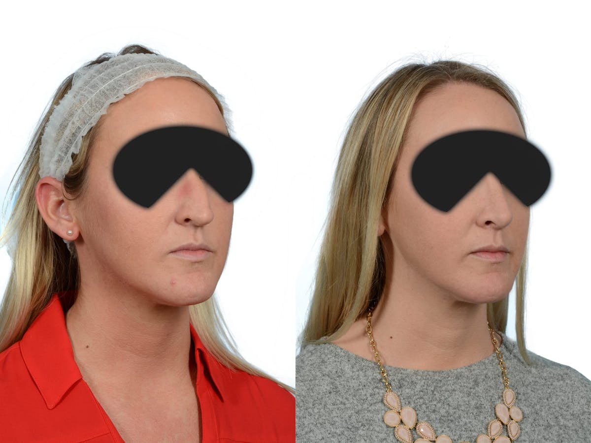 Rhinoplasty Before & After Gallery - Patient 167212 - Image 2