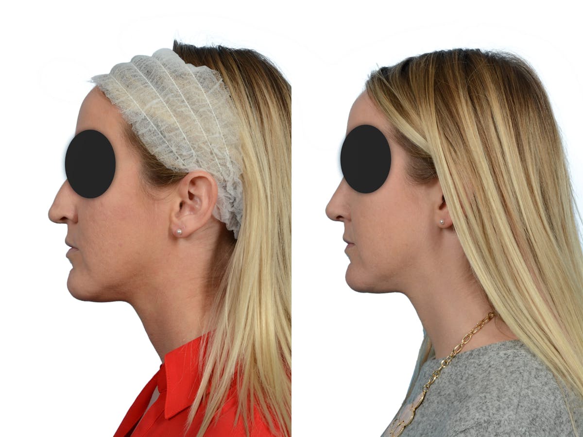 Rhinoplasty Before & After Gallery - Patient 167212 - Image 5