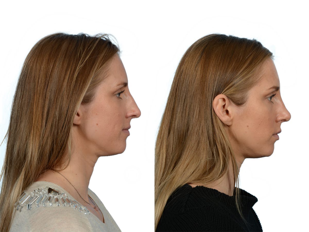 Rhinoplasty Before & After Gallery - Patient 272291 - Image 1