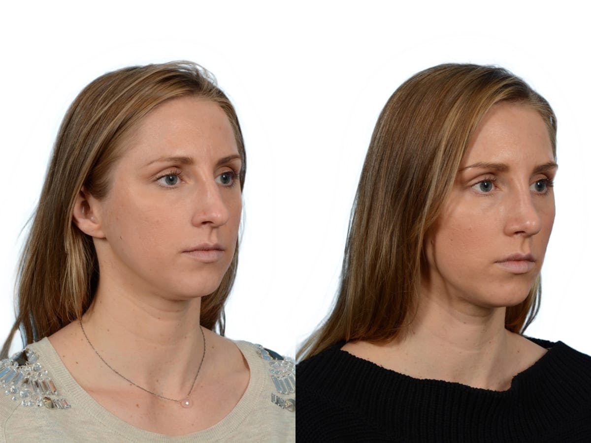 Rhinoplasty Before & After Gallery - Patient 272291 - Image 2