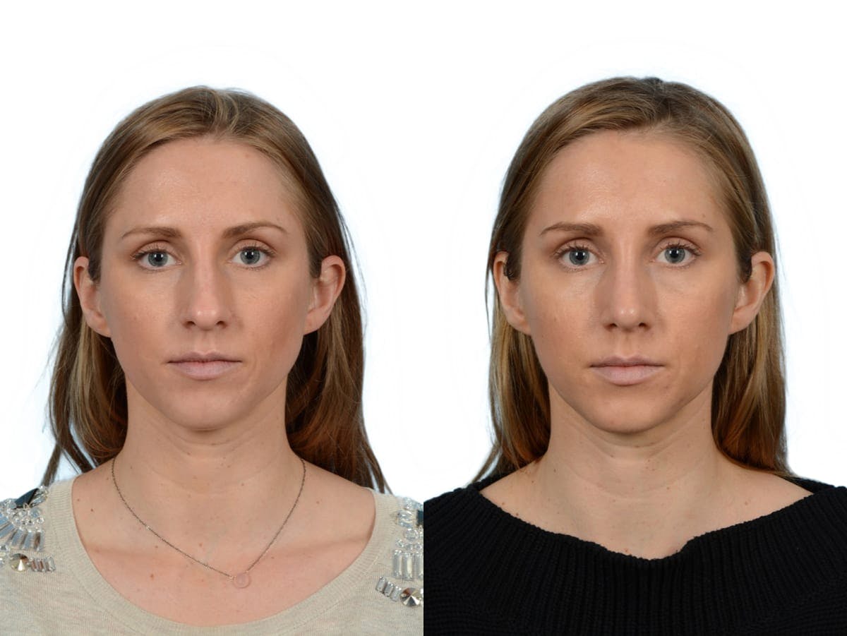 Rhinoplasty Before & After Gallery - Patient 272291 - Image 3