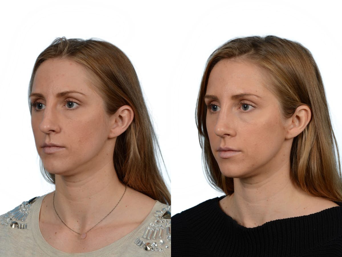 Rhinoplasty Before & After Gallery - Patient 272291 - Image 4