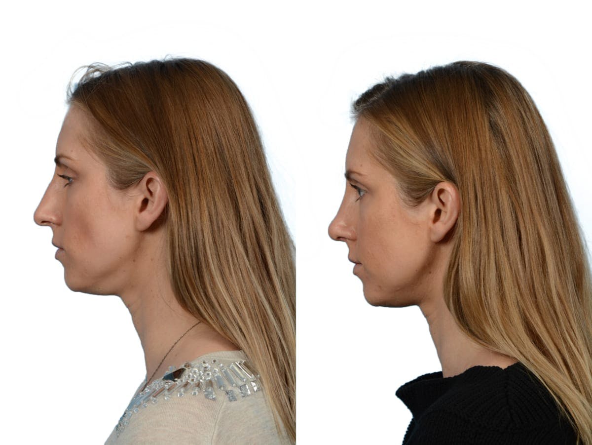 Rhinoplasty Before & After Gallery - Patient 272291 - Image 5