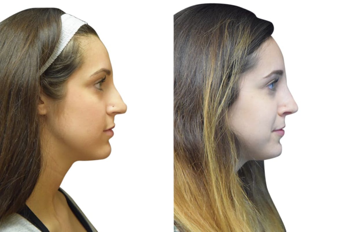 Rhinoplasty Before & After Gallery - Patient 347394 - Image 1