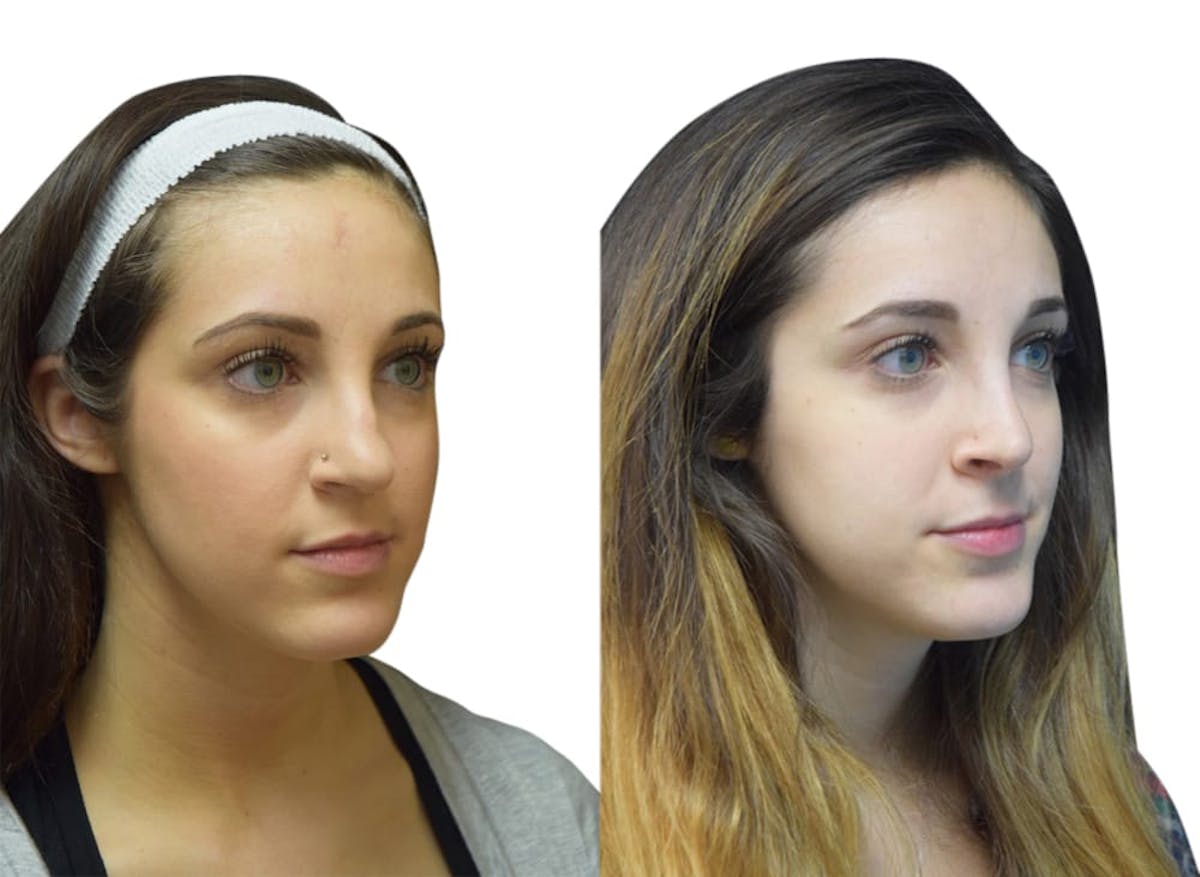 Rhinoplasty Before & After Gallery - Patient 347394 - Image 2
