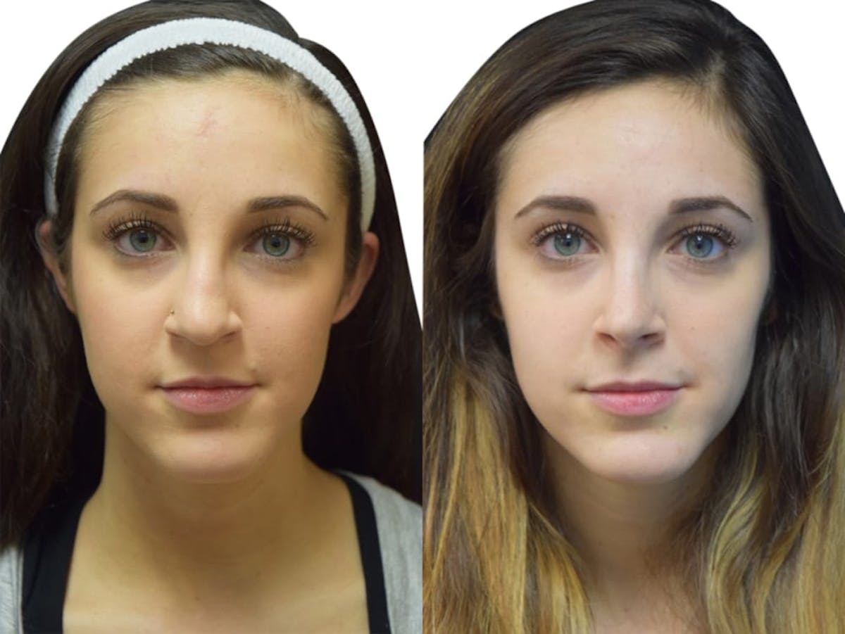 Rhinoplasty Before & After Gallery - Patient 347394 - Image 3