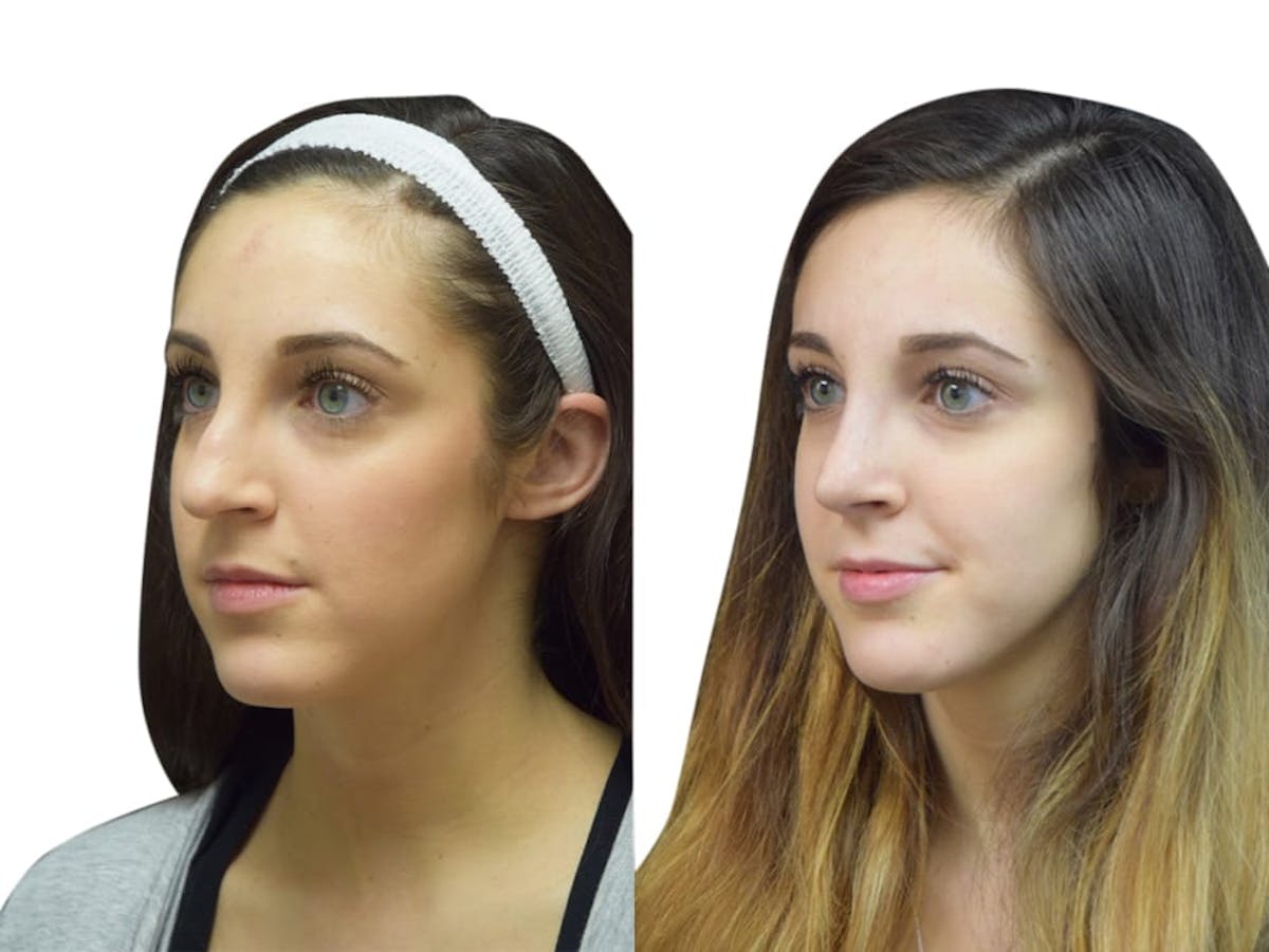 Rhinoplasty Before & After Gallery - Patient 347394 - Image 4