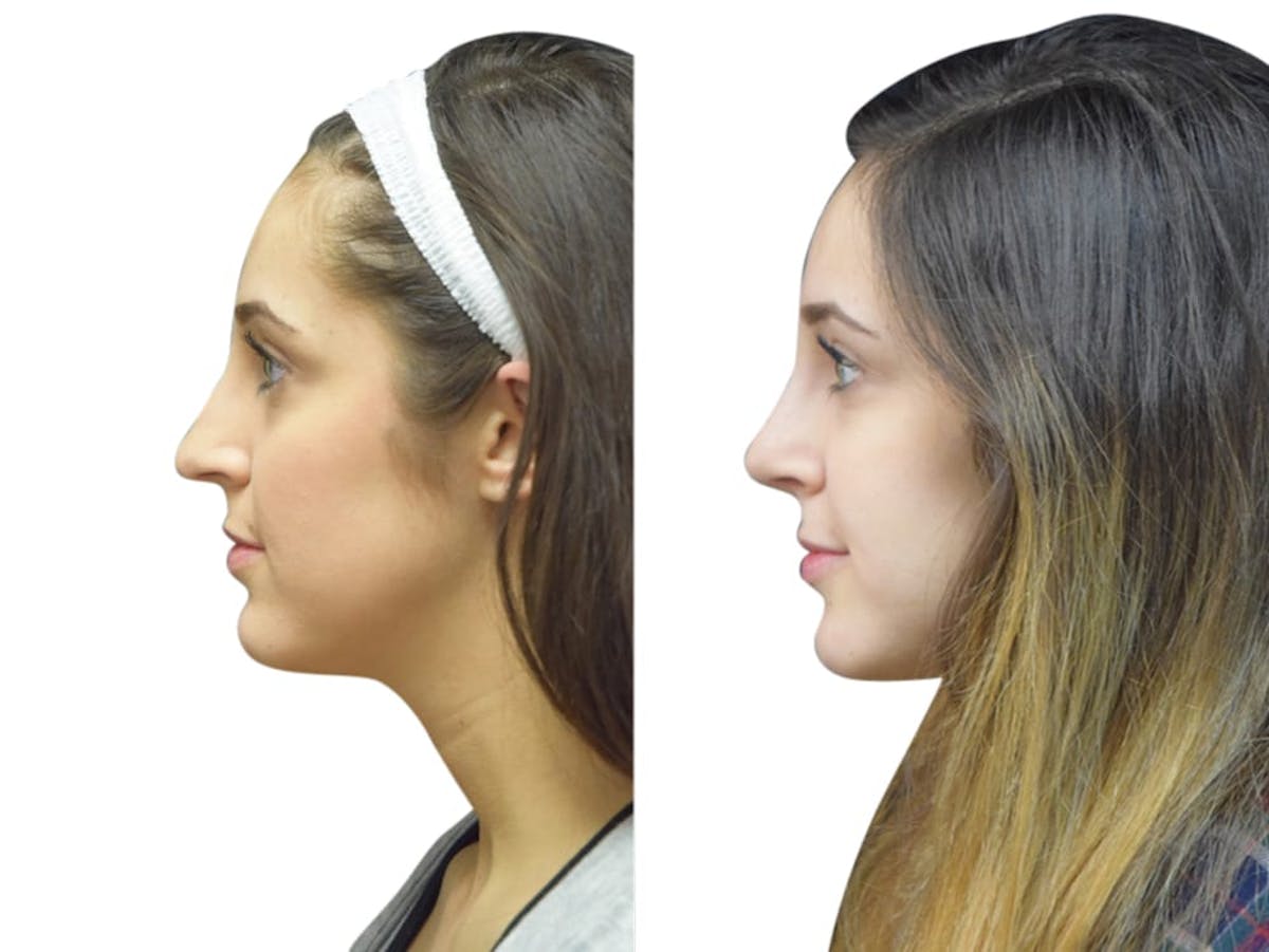 Rhinoplasty Before & After Gallery - Patient 347394 - Image 5
