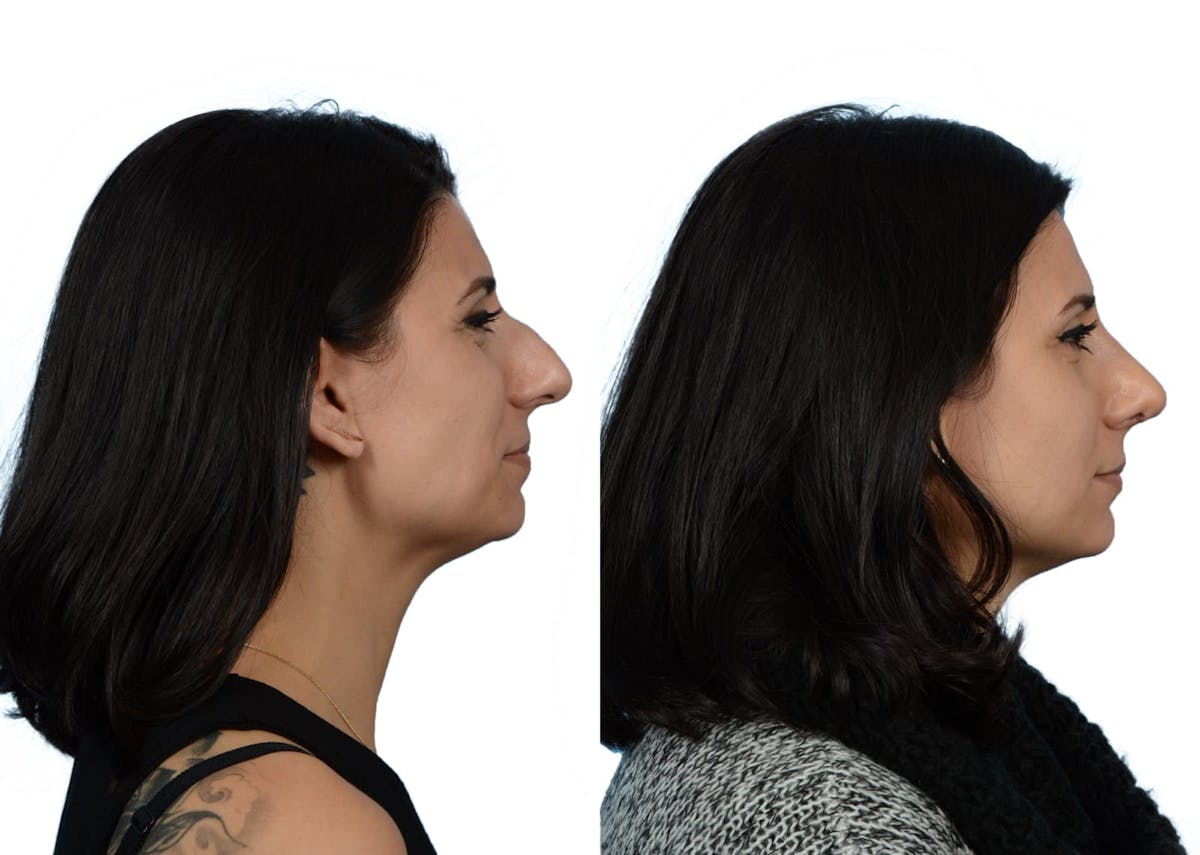 Rhinoplasty Before & After Gallery - Patient 258556 - Image 1