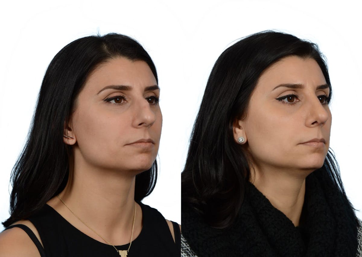 Rhinoplasty Before & After Gallery - Patient 258556 - Image 2