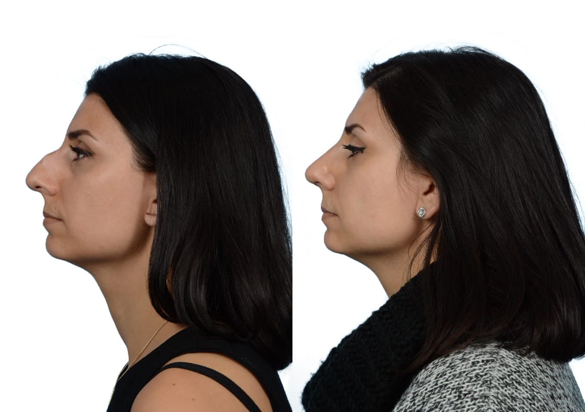 Rhinoplasty Before & After Gallery - Patient 258556 - Image 3