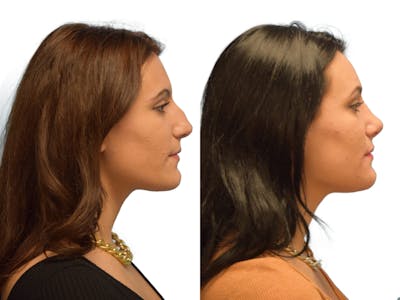 Rhinoplasty Before & After Gallery - Patient 387778 - Image 1