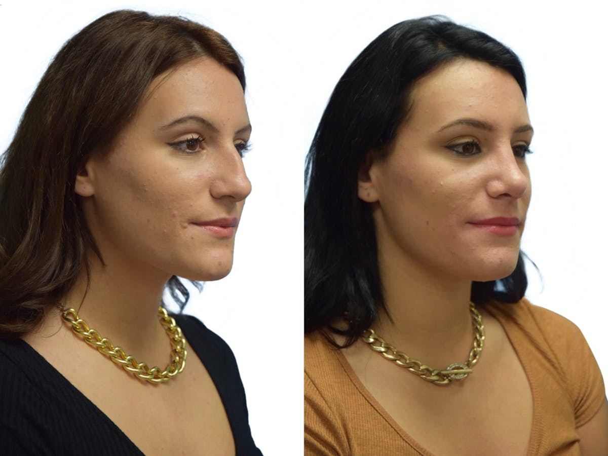 Rhinoplasty Before & After Gallery - Patient 387778 - Image 2