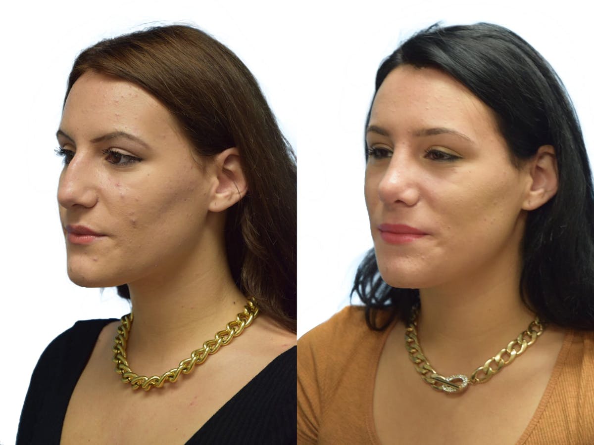 Rhinoplasty Before & After Gallery - Patient 387778 - Image 3