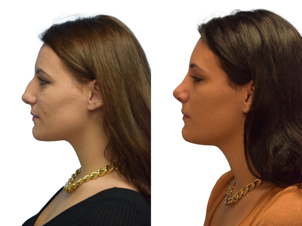 Rhinoplasty Before & After Gallery - Patient 387778 - Image 4