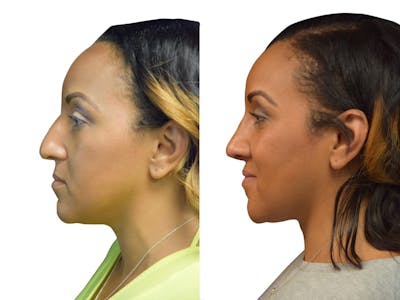 Rhinoplasty Before & After Gallery - Patient 283475 - Image 1