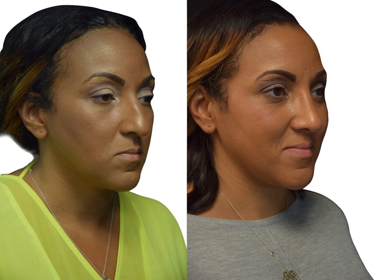 Rhinoplasty Before & After Gallery - Patient 283475 - Image 2