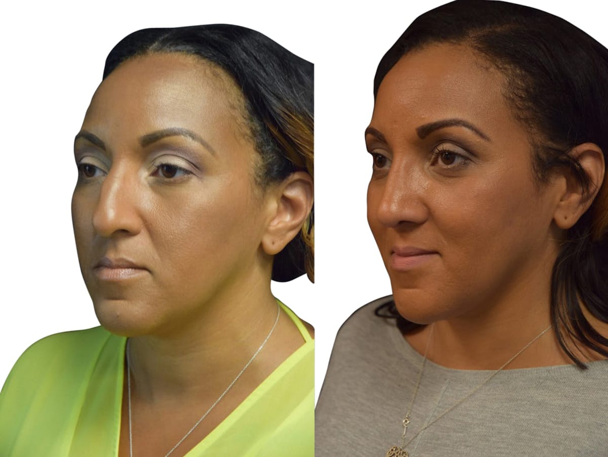 Rhinoplasty Before & After Gallery - Patient 283475 - Image 3