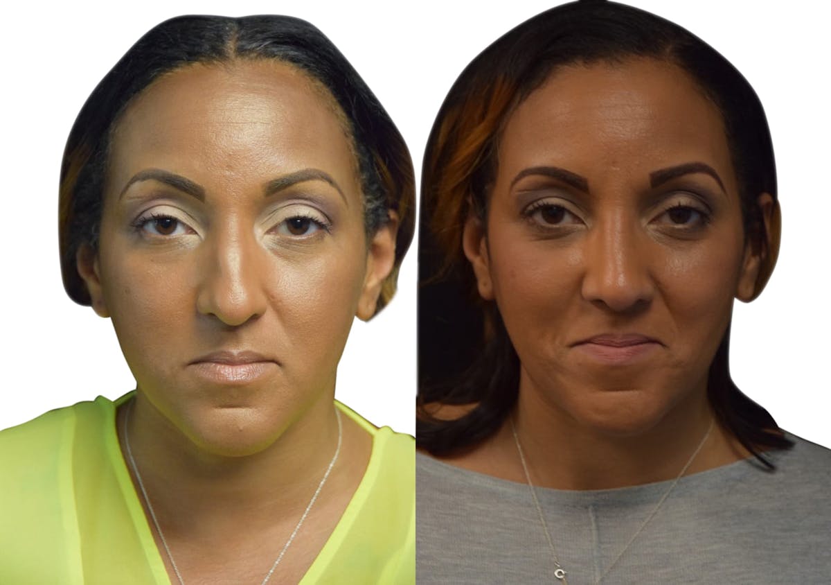 Rhinoplasty Before & After Gallery - Patient 283475 - Image 4