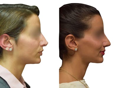 Rhinoplasty Before & After Gallery - Patient 408744 - Image 1