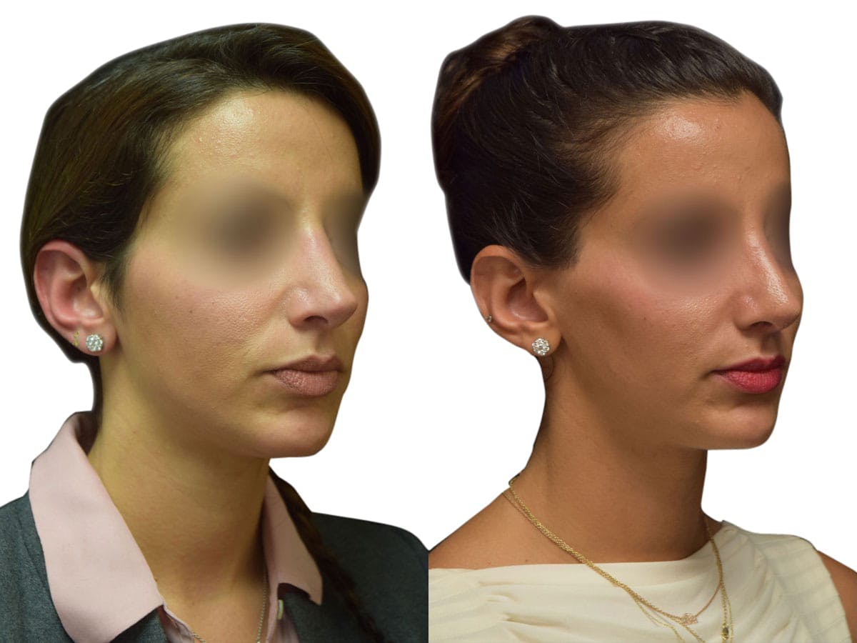 Rhinoplasty Before & After Gallery - Patient 408744 - Image 2