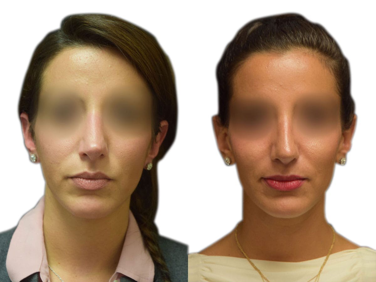 Rhinoplasty Before & After Gallery - Patient 408744 - Image 3