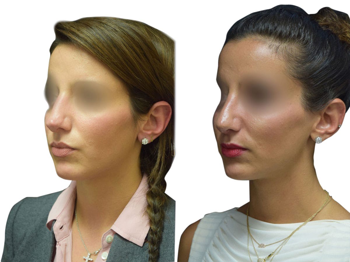 Rhinoplasty Before & After Gallery - Patient 408744 - Image 4