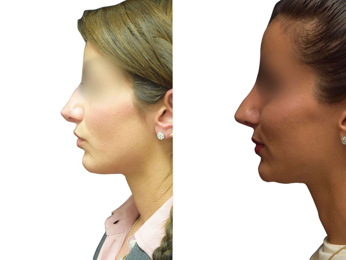 Rhinoplasty Before & After Gallery - Patient 408744 - Image 5