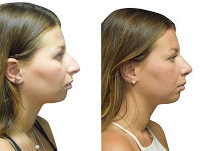 Rhinoplasty Before & After Gallery - Patient 134728 - Image 1