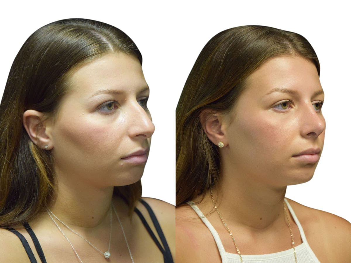 Rhinoplasty Before & After Gallery - Patient 134728 - Image 2