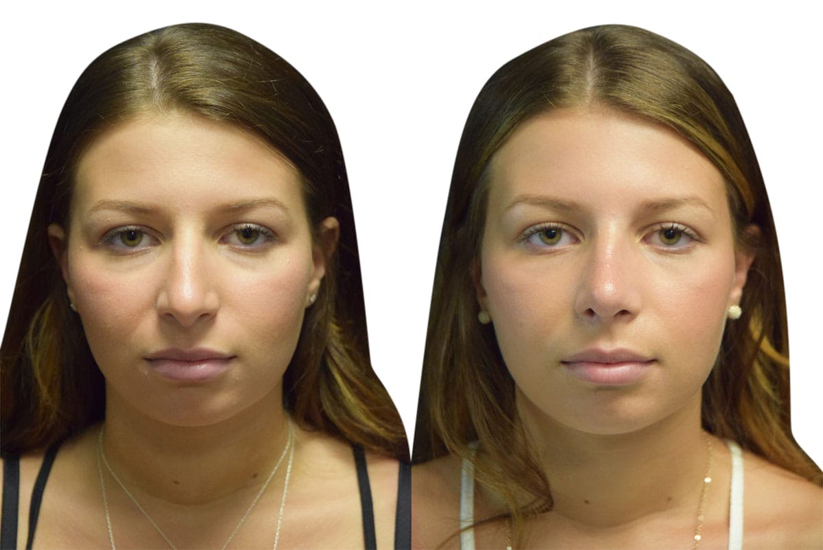 Rhinoplasty Before & After Gallery - Patient 134728 - Image 3