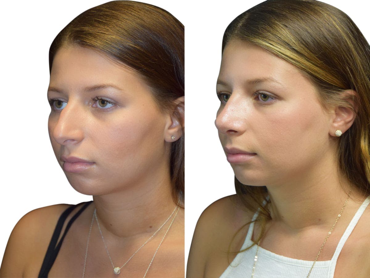 Rhinoplasty Before & After Gallery - Patient 134728 - Image 4