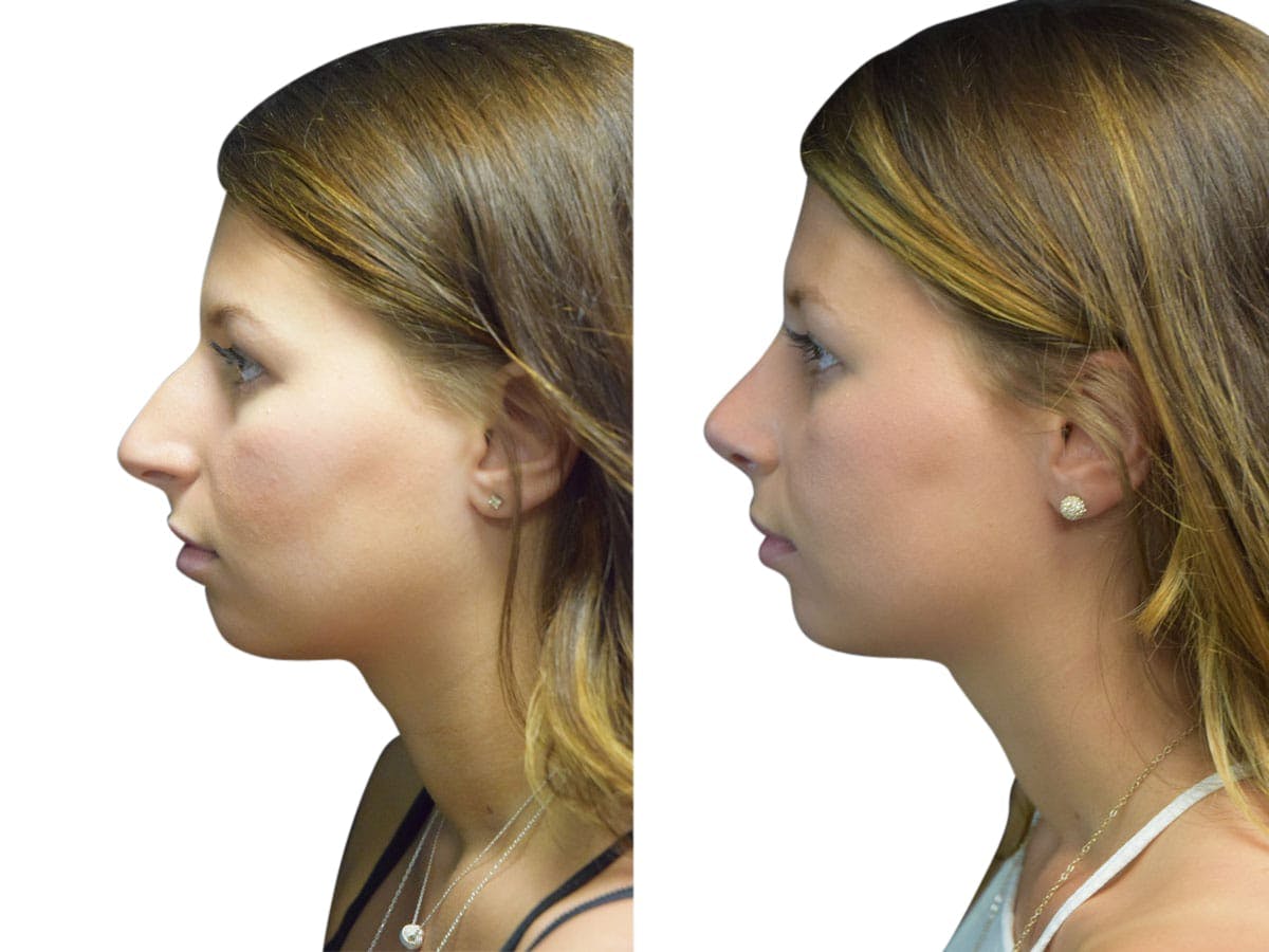 Rhinoplasty Before & After Gallery - Patient 134728 - Image 5
