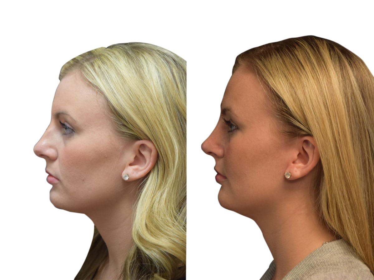 Rhinoplasty Before & After Gallery - Patient 320592 - Image 1