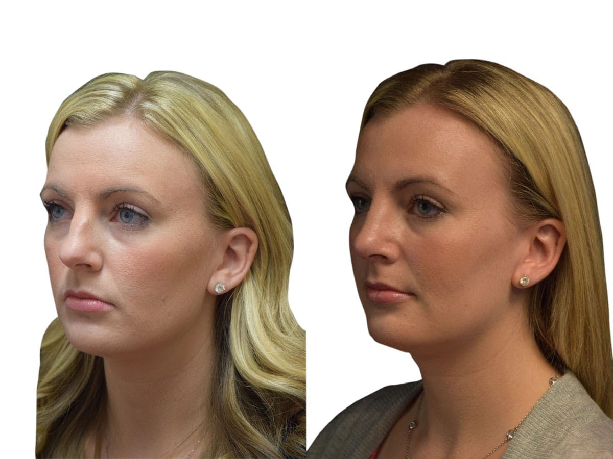 Rhinoplasty Before & After Gallery - Patient 320592 - Image 2