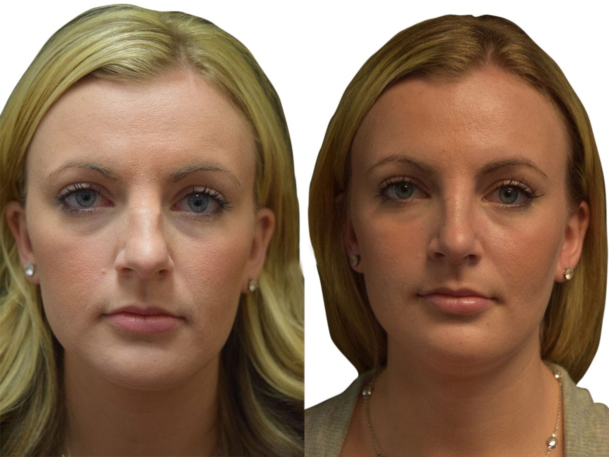 Rhinoplasty Before & After Gallery - Patient 320592 - Image 3