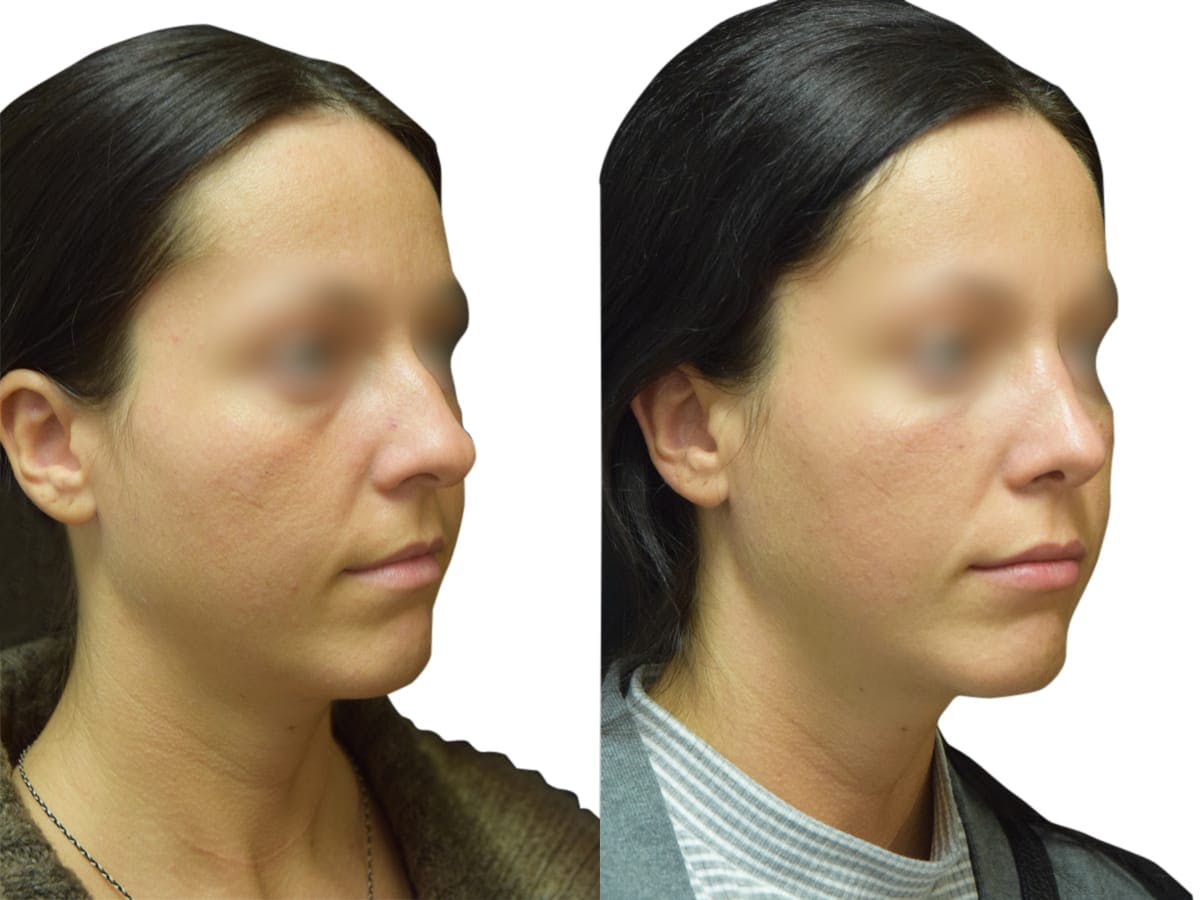Rhinoplasty Before & After Gallery - Patient 383933 - Image 2