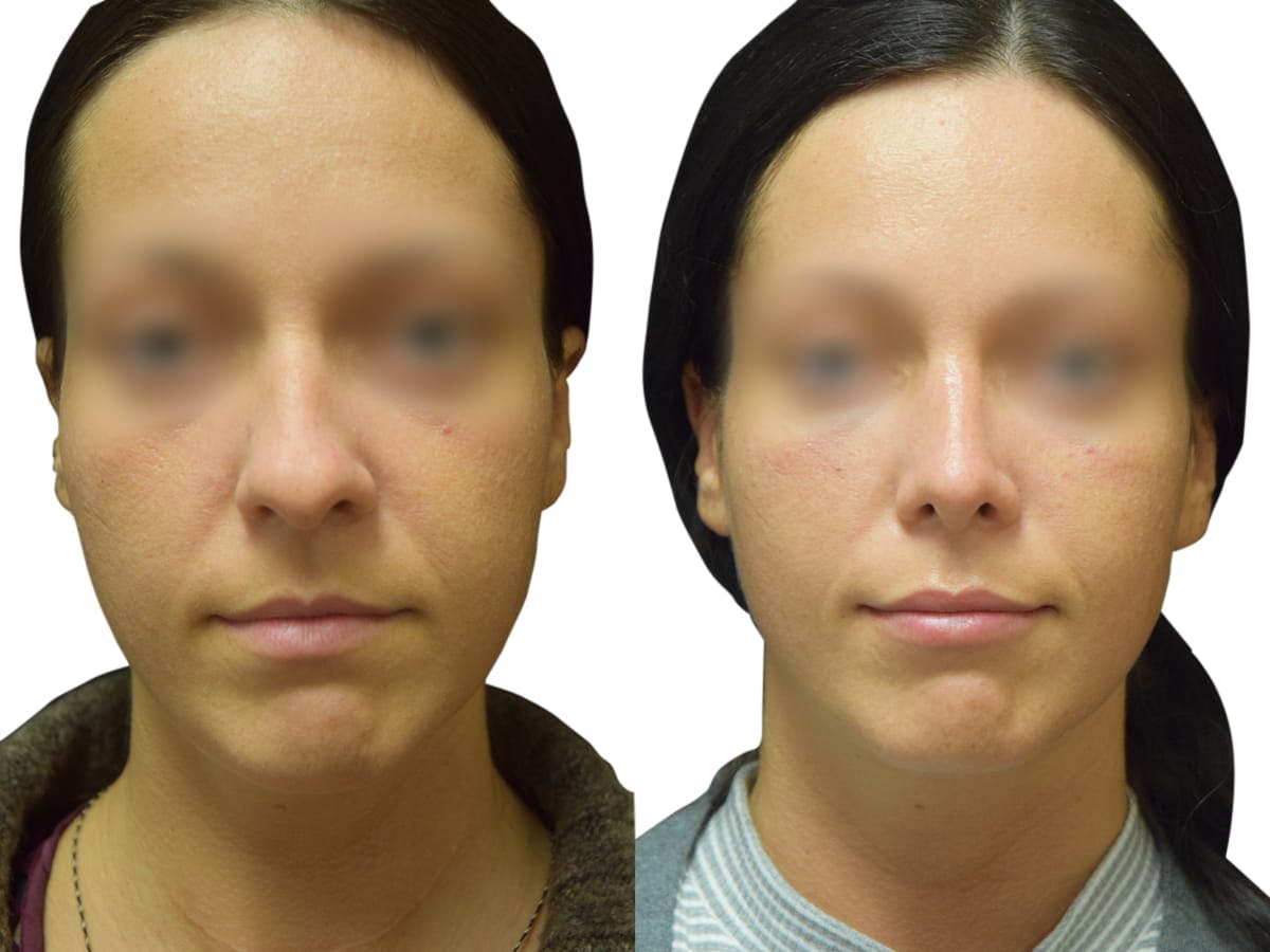 Rhinoplasty Before & After Gallery - Patient 383933 - Image 3