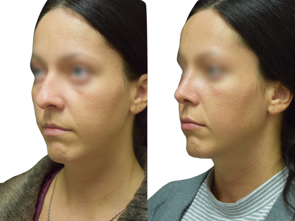 Rhinoplasty Before & After Gallery - Patient 383933 - Image 4