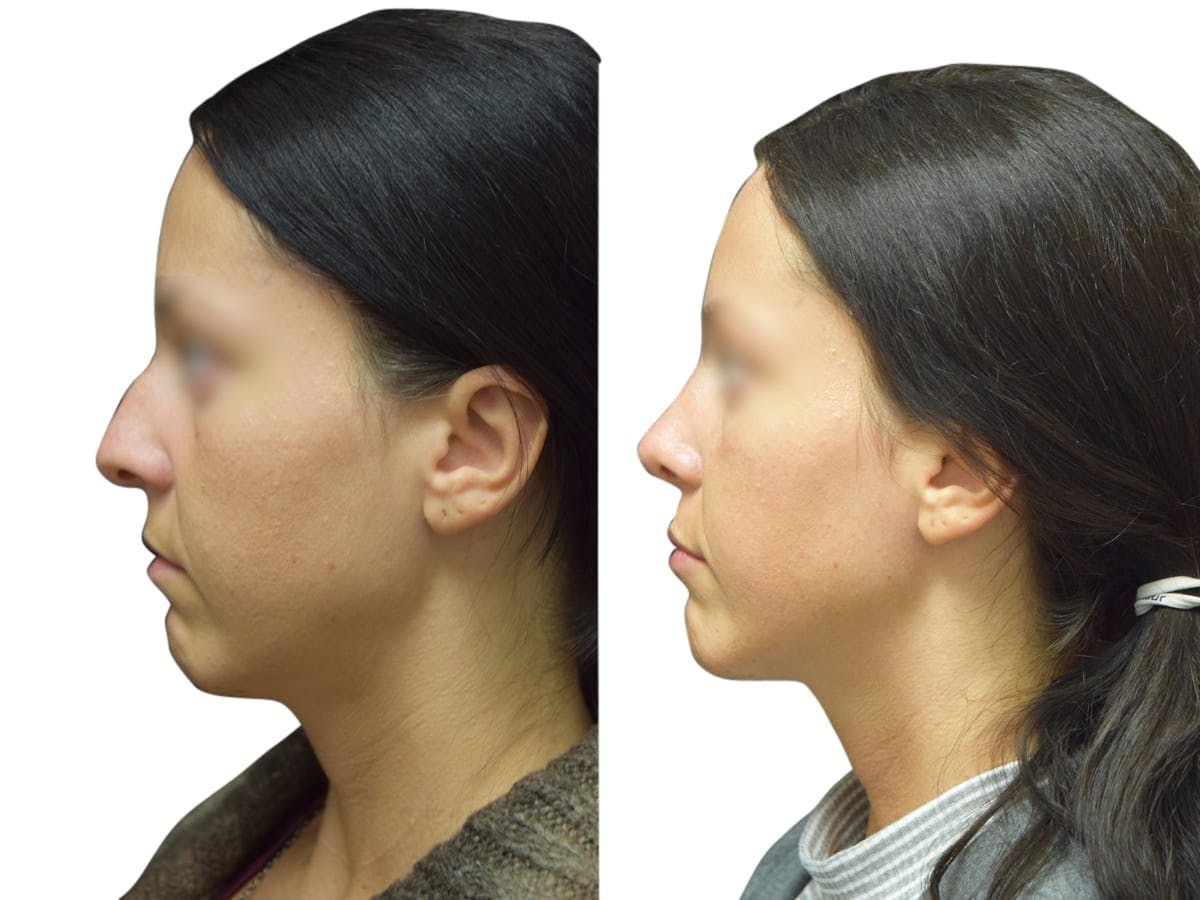 Rhinoplasty Before & After Gallery - Patient 383933 - Image 5