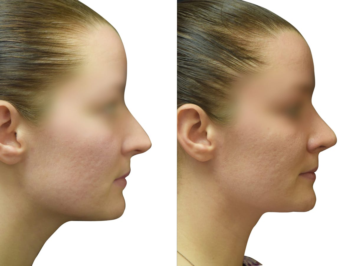 Rhinoplasty Before & After Gallery - Patient 251778 - Image 1