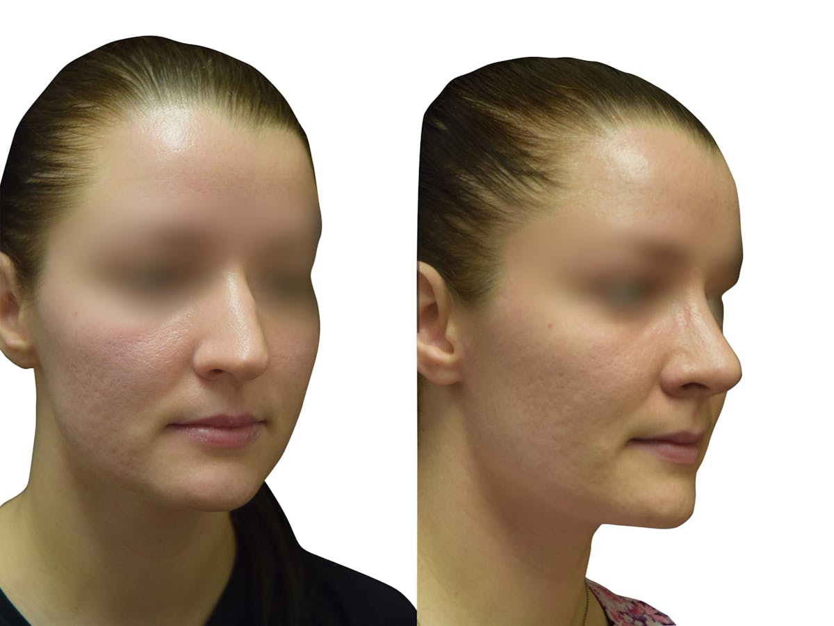 Rhinoplasty Before & After Gallery - Patient 251778 - Image 2