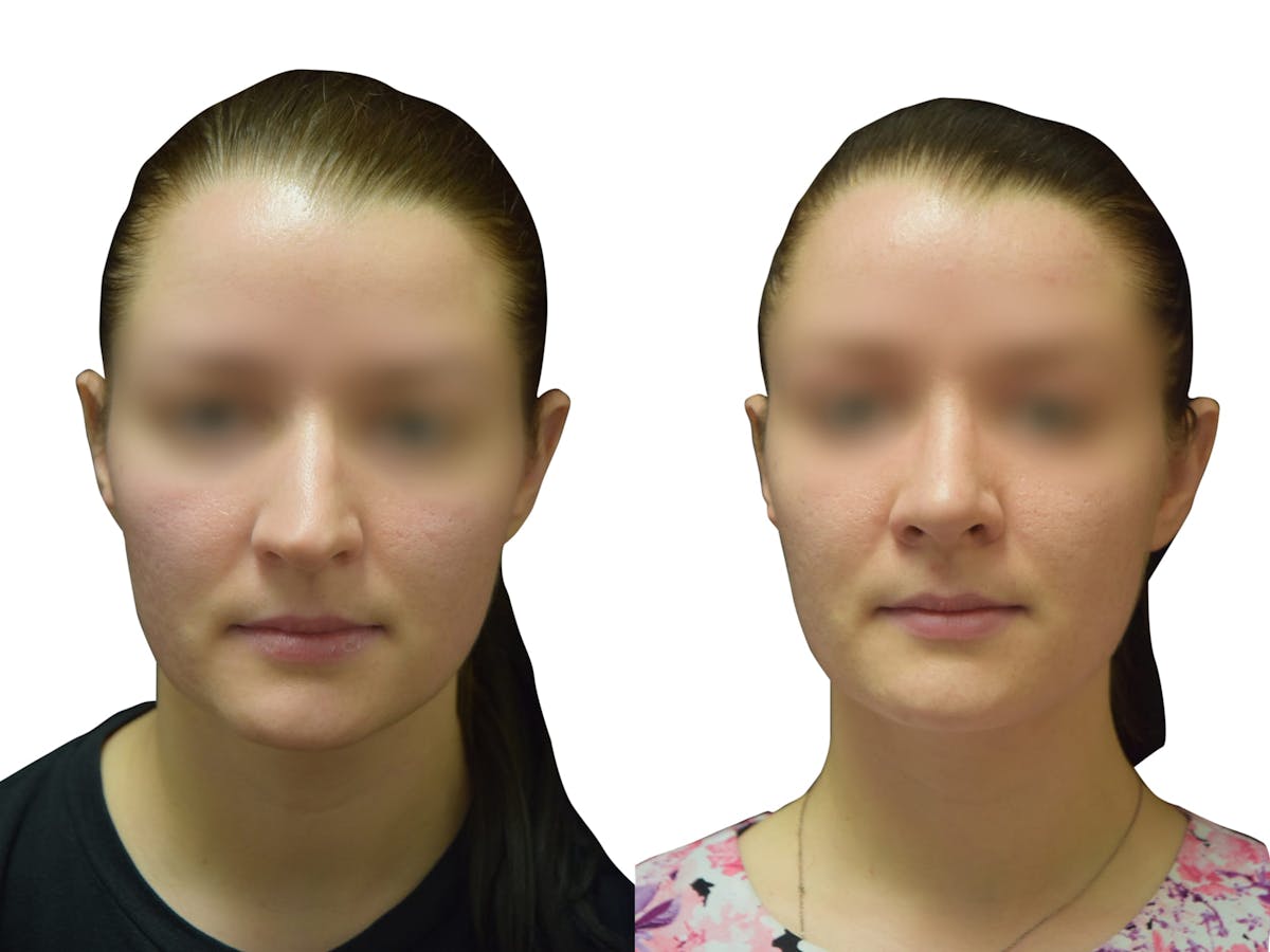 Rhinoplasty Before & After Gallery - Patient 251778 - Image 3