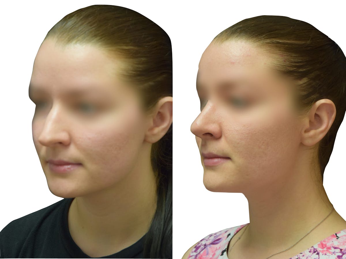 Rhinoplasty Before & After Gallery - Patient 251778 - Image 4