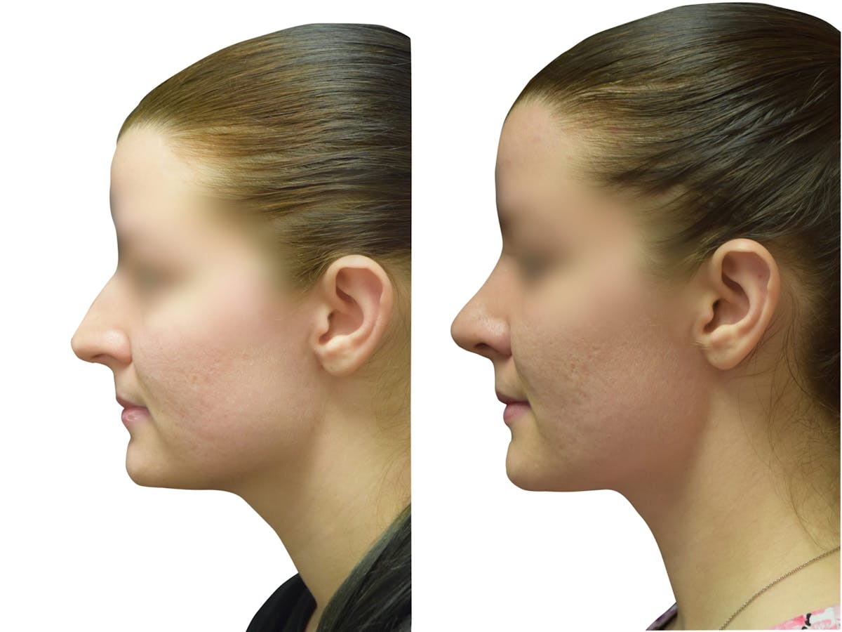 Rhinoplasty Before & After Gallery - Patient 251778 - Image 5