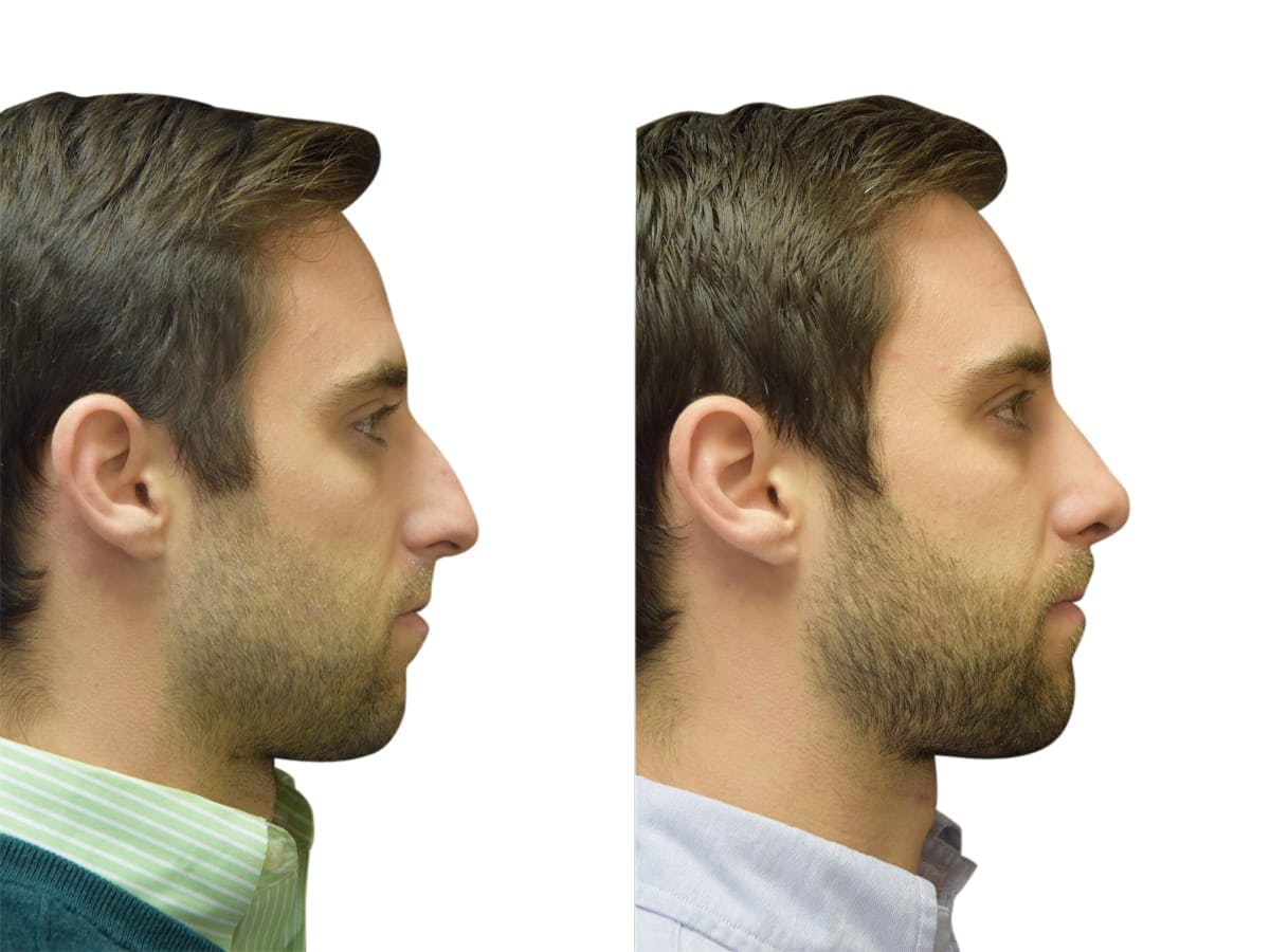 Rhinoplasty Before & After Gallery - Patient 310603 - Image 1